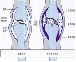 也没想象中那么严重—类风湿性关节炎不用药的日子 类风湿性关节炎