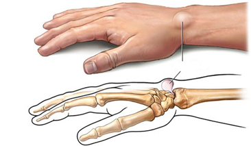 中医解析腱鞘舒筋贴的主要成分 腱鞘炎痛舒贴价格