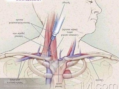 锁骨下静脉穿刺置管术的改进 锁骨下静脉穿刺定位
