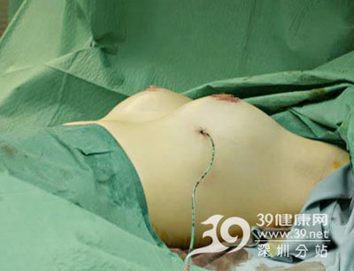 【隆胸手术】隆胸过程照片隆胸日记【多图】 隆胸手术过程实拍