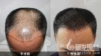 男性脂溢性脱发（雄激素源性脱发）可以治疗 男性脂溢性脱发的治疗