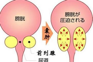 前列腺的注意事项 生南瓜子治疗前列腺 ：2013-12-25 南瓜子治疗前列腺囊肿