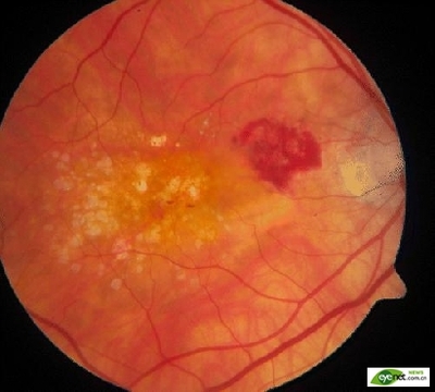 黄斑变性和陈旧性黄斑出血的治疗 黄斑变性眼底出血