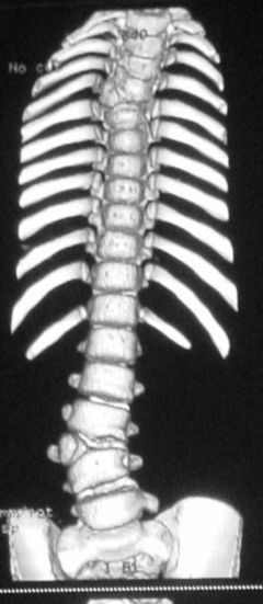 关于脊柱侧弯手术的一些问题。 脊柱侧弯手术视频