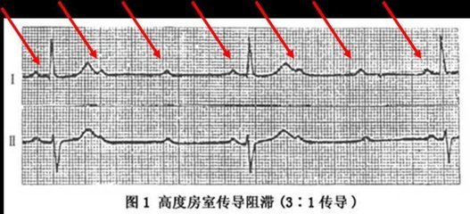 我需要安装心脏起搏器吗？----3度房室传导阻滞 心脏右束支传导阻滞