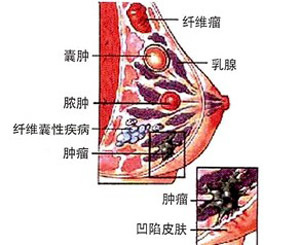 浆细胞性乳腺炎 浆细胞性乳腺炎治疗