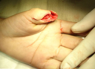 拇指与手指缺损分度及手指再造要求 耳缺损再造