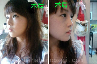 【韩国整容】隆鼻前后对比隆鼻手术后变甜美女孩的小福楠 注射隆鼻整容手术医院