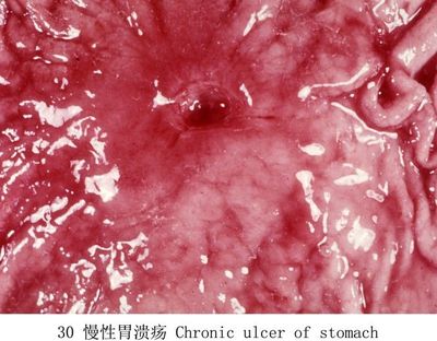 病理学园地：应激性溃疡——病例分析