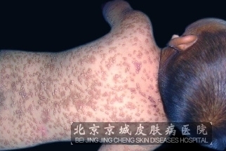 北京治疗荨麻疹较好的医院 怎样治疗荨麻疹比较好