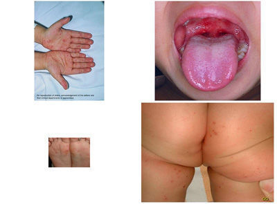 手口足病的症状 手足口病症状图片