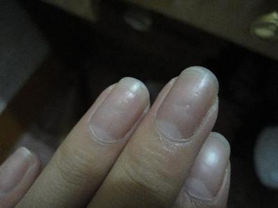 指甲表面凹凸不平是什么原因 手指甲凹凸不平增厚