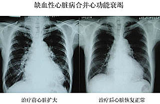 扩心病 什么叫扩心病