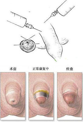包皮手术全过程（图解）。 做包皮手术的过程