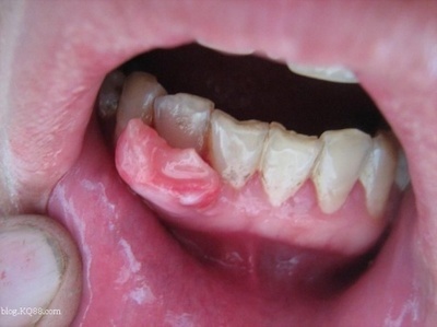 牙龈肿痛的原因和牙龈肿痛的治疗方法 牙龈肿痛的原因