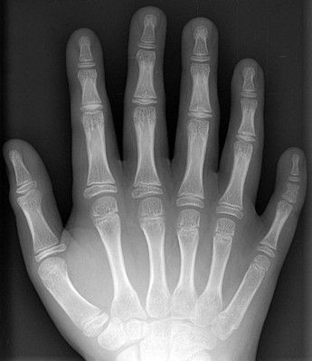 六根手指的外星人 六根手指