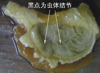 福寿螺感染广州管圆线虫检测方法与检测注意事项 尿路感染注意事项