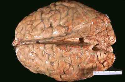 营养与毒性元素分析 病毒性脑炎怎么营养