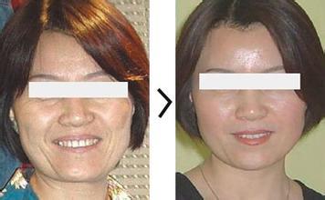opt激光美容做几次皮肤会变好 皮肤激光美容多少钱