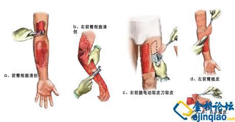 植皮手术多少钱 80%烧伤植皮手术多少钱