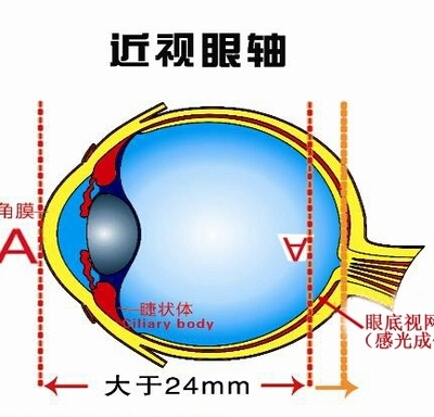 近视的发生和发展，以及近视为什么会不断加深（原创） 不戴眼镜会加深近视