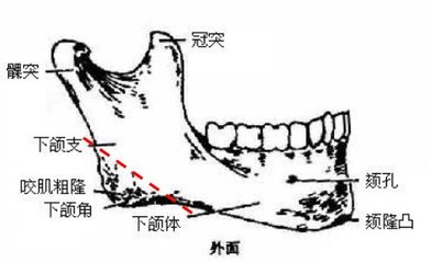 韩国长曲线下颌角截骨术（手术效果展示） 下颌角截骨手术