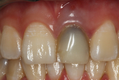 什么是“根管治疗”？什么是牙齿杀神经？ 根管治疗杀神经