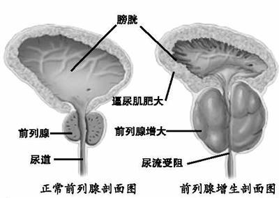 良性前列腺增生症（BPH）临床进展的危险因素分析 良性前列腺增生症