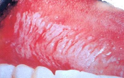口腔黏膜白斑的原因和治疗方法 口腔黏膜白斑病