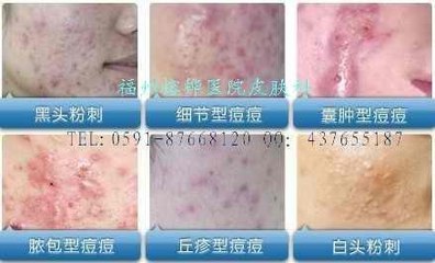 粉刺痤疮皮肤的护理常见问题 痤疮粉刺的治疗方法