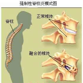 强直性脊柱炎的诊断与治疗 强直性脊柱炎 诊断