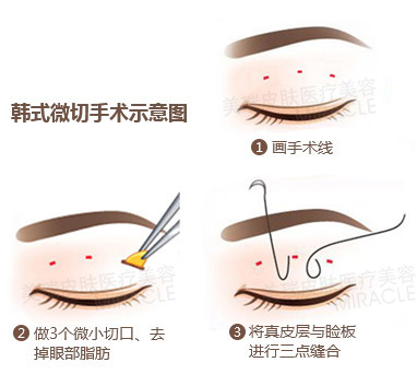 韩式无痕翘睫双眼皮——四大精品手术之一 翘睫无痕双眼皮的优势