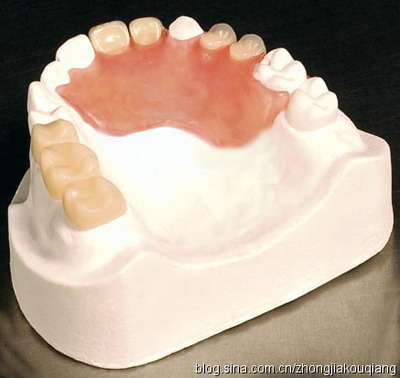 弹性隐形义齿修复牙齿缺失的优缺点 隐形义齿的优缺点