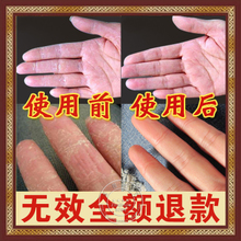 手脱皮怎么治疗-新肤康美软膏治疗手蜕皮季节性手脱皮 季节性手蜕皮