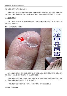 关于小脚趾复趾与汉族特性 汉族人的小脚趾