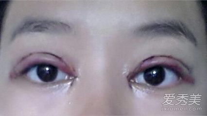 双眼皮+开眼角第一次沈阳百嘉丽汪晓蕾失败 韩式双眼皮开眼角图片