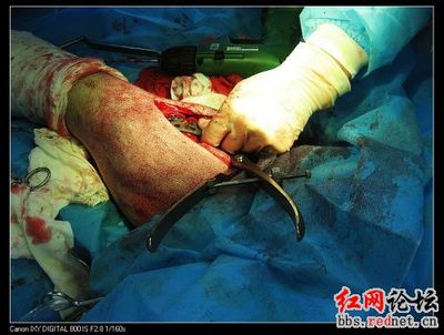 大熊猫打群架摔断腿，手术治疗有望康复（组图） 大熊猫宝宝满月