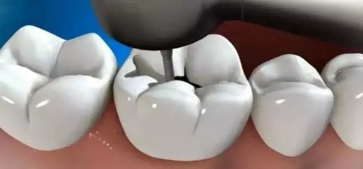 (转载)给孩子补牙全过程 补牙过程图解