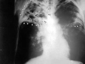 胸部CT扫描 肺结核的早期症状