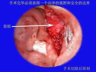 耳前瘘管治疗经历 不手术治疗耳前瘘管