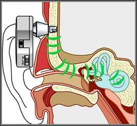 助听器工作原理 骨导式助听器原理