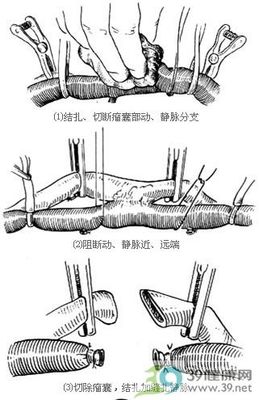 动静脉内瘘术 动静脉内瘘的护理