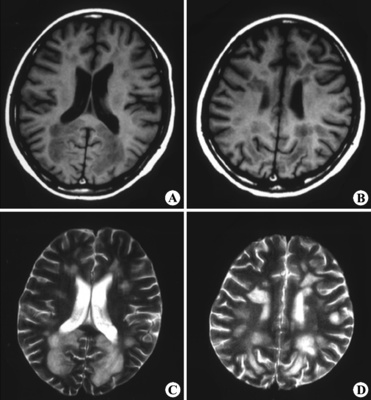 脑白质脱髓鞘影像学CT表现 轻度脑白质脱髓鞘改变