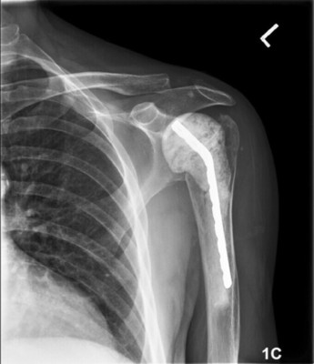肩关节系列之--肩胛带的解剖与功能 肩关节mri解剖