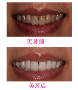 牙齿漂白技术 漂白牙齿一般多少钱