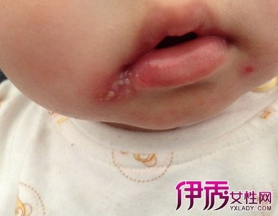 宝宝长水疱疹 宝宝嘴巴长疱疹