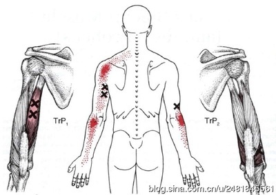 激痛点和肌肉疼痛自我按摩治疗（10）------背部疼痛 背部肌肉锻炼
