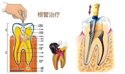 根管治疗的步骤根管治疗费用 口腔根管治疗的步骤