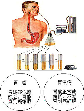 做钡餐~ 做钡餐注意事项