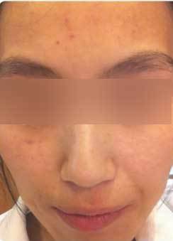 脸部保湿保养比较体验-水光注射VS韩国cjinnerb胶原蛋白胶囊 胶原蛋白脸部注射